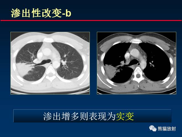 【PPT】肺结核的基础CT表现