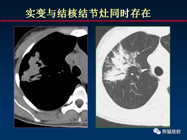 【PPT】肺结核的基础CT表现