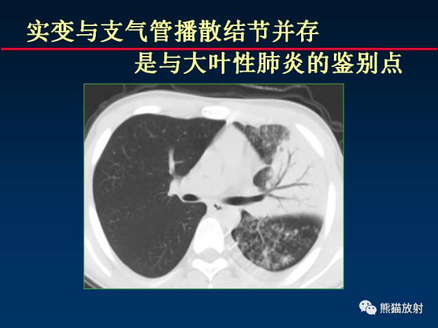 【PPT】肺结核的基础CT表现