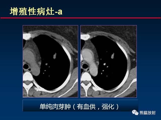 【PPT】肺结核的基础CT表现