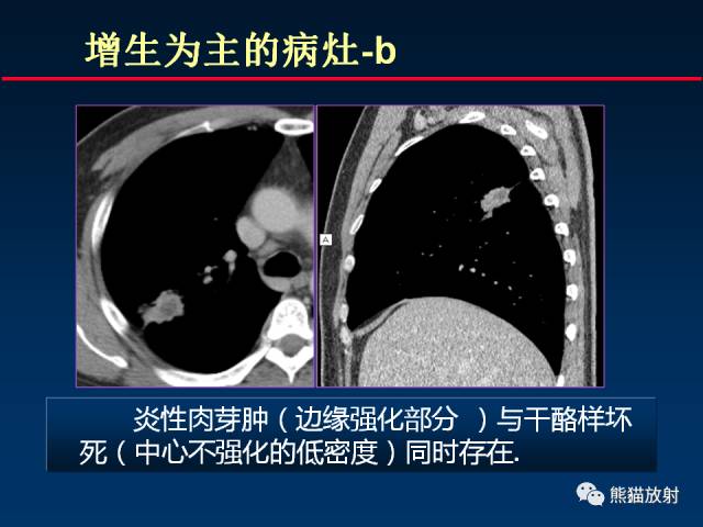 【PPT】肺结核的基础CT表现