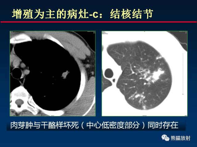 【PPT】肺结核的基础CT表现