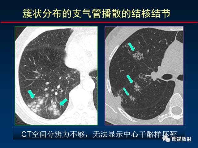 【PPT】肺结核的基础CT表现