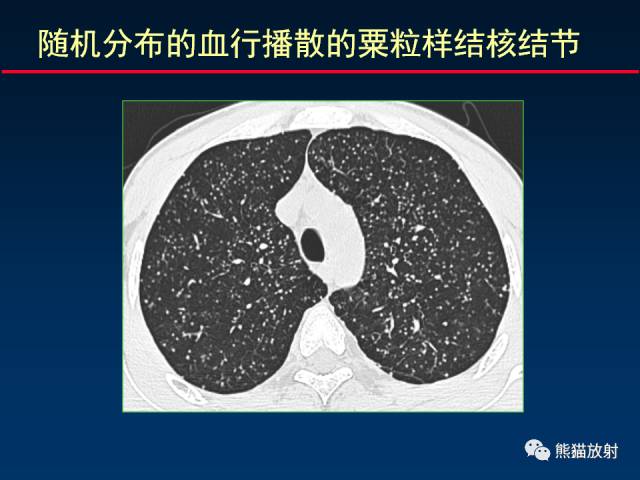 【PPT】肺结核的基础CT表现