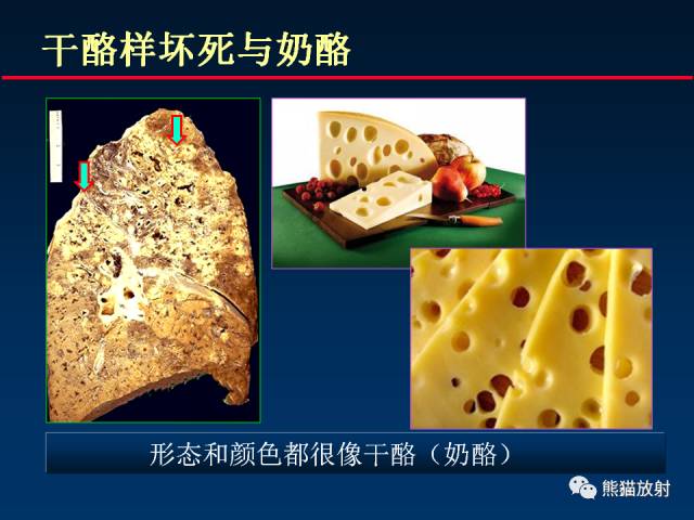 【PPT】肺结核的基础CT表现