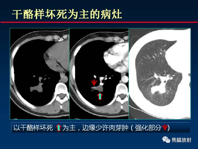 【PPT】肺结核的基础CT表现