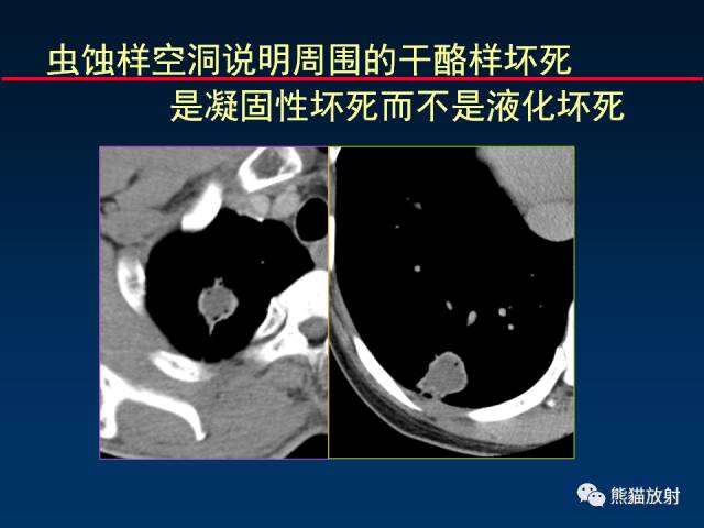 【PPT】肺结核的基础CT表现