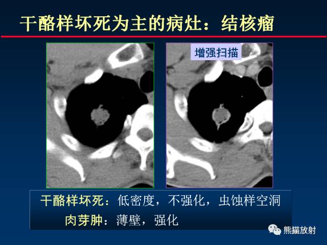【PPT】肺结核的基础CT表现