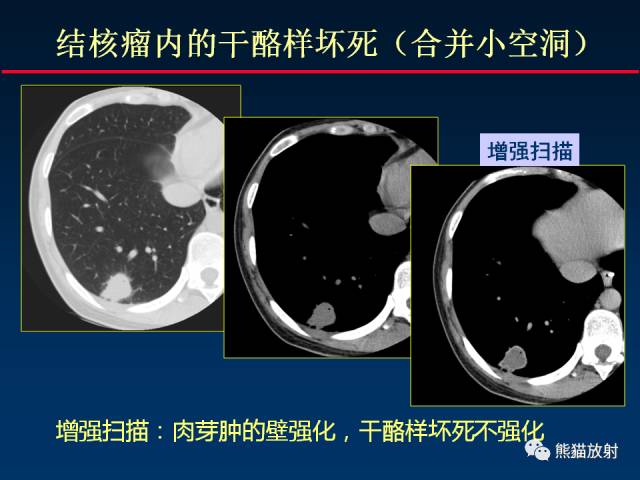 【PPT】肺结核的基础CT表现