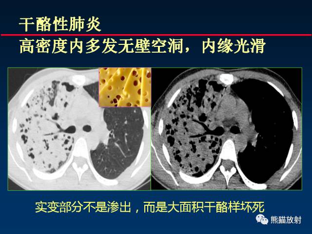 【PPT】肺结核的基础CT表现