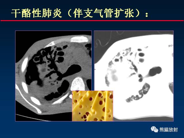 【PPT】肺结核的基础CT表现