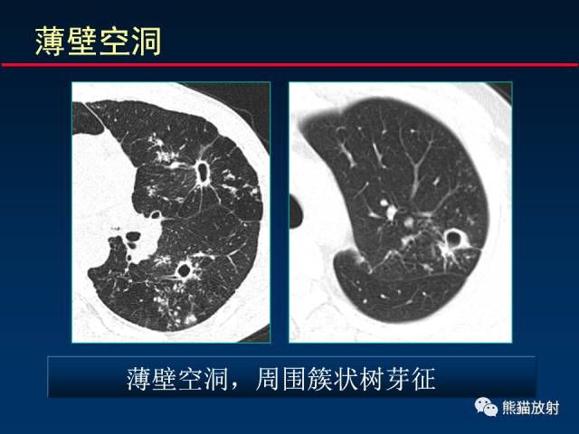 【PPT】肺结核的基础CT表现