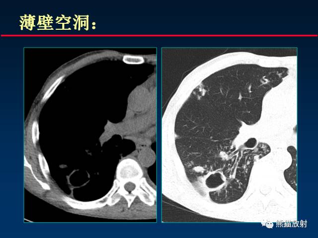 【PPT】肺结核的基础CT表现