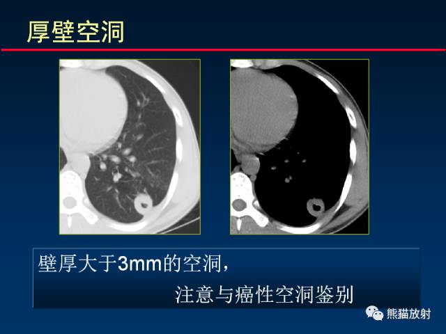 【PPT】肺结核的基础CT表现
