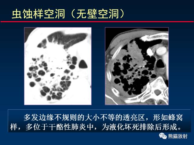 【PPT】肺结核的基础CT表现