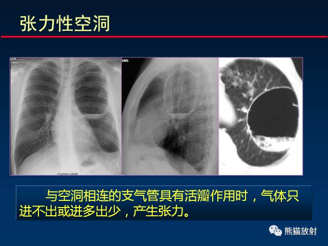 【PPT】肺结核的基础CT表现