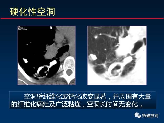 【PPT】肺结核的基础CT表现