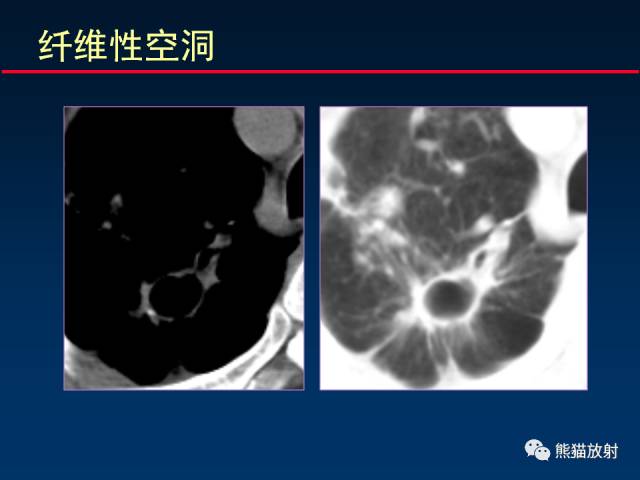 【PPT】肺结核的基础CT表现