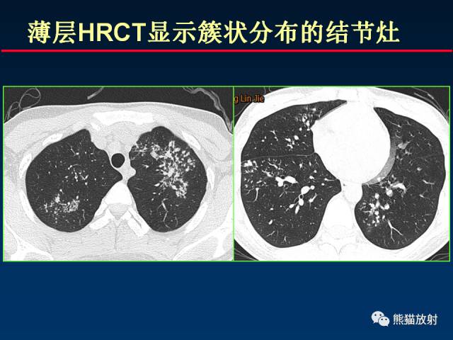 【PPT】肺结核的基础CT表现
