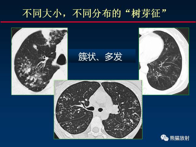 【PPT】肺结核的基础CT表现