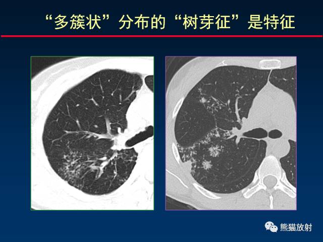 【PPT】肺结核的基础CT表现