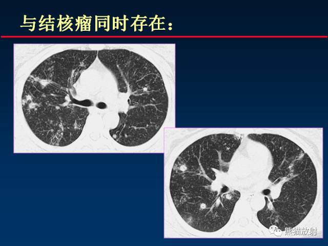 【PPT】肺结核的基础CT表现