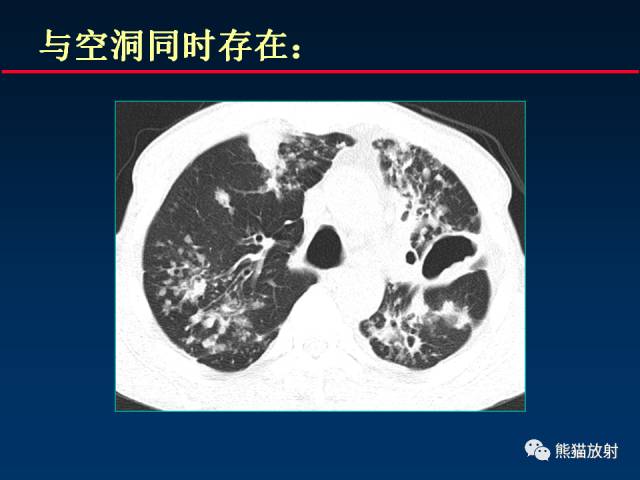 【PPT】肺结核的基础CT表现