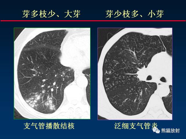 【PPT】肺结核的基础CT表现