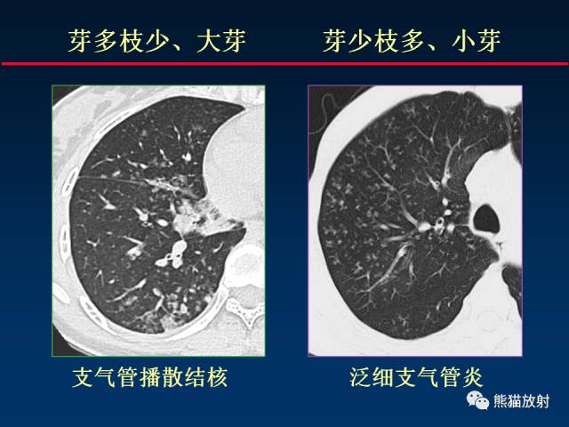 【PPT】肺结核的基础CT表现