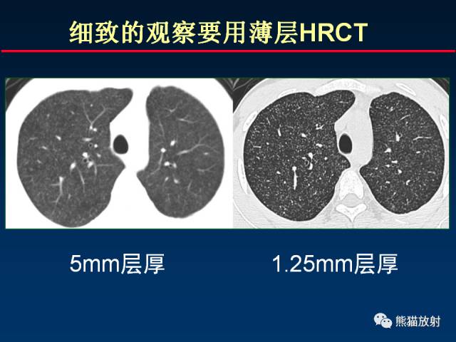 【PPT】肺结核的基础CT表现