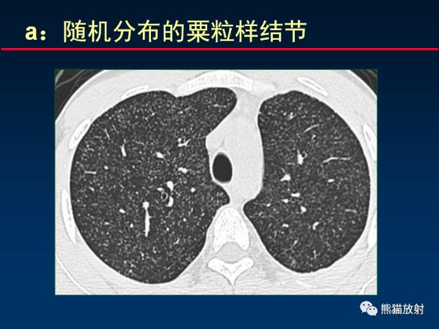 【PPT】肺结核的基础CT表现
