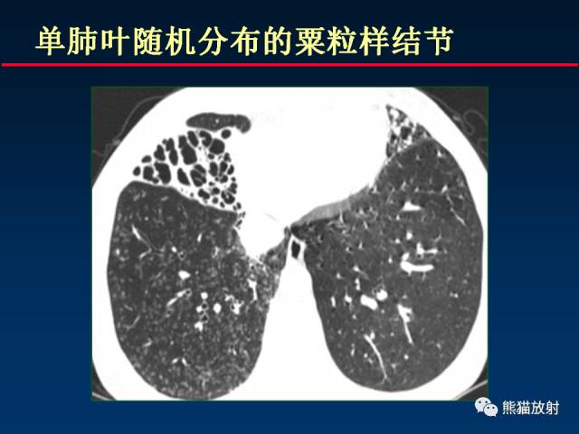 【PPT】肺结核的基础CT表现