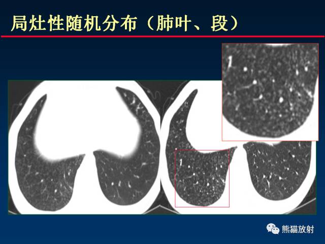 【PPT】肺结核的基础CT表现