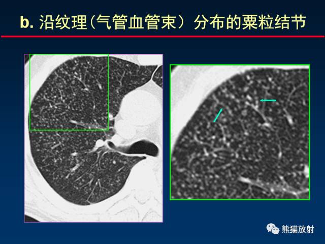 【PPT】肺结核的基础CT表现