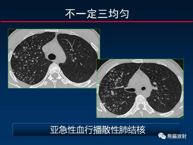 【PPT】肺结核的基础CT表现