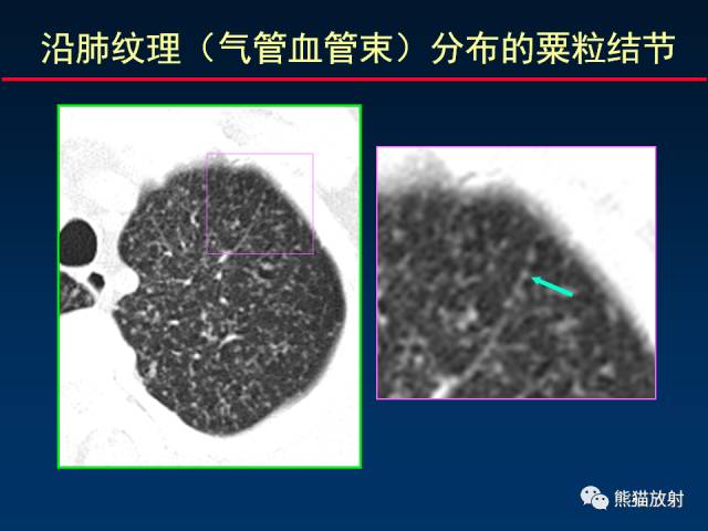 【PPT】肺结核的基础CT表现