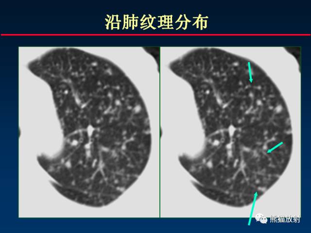 【PPT】肺结核的基础CT表现