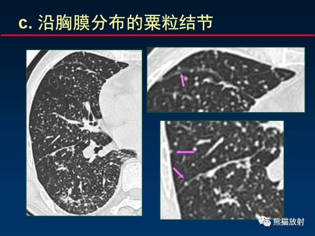 【PPT】肺结核的基础CT表现