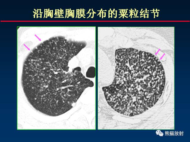 【PPT】肺结核的基础CT表现