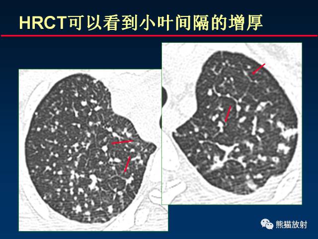 【PPT】肺结核的基础CT表现