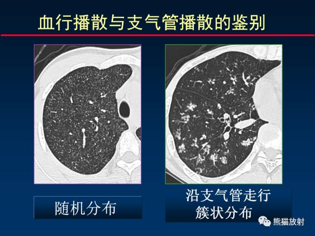 【PPT】肺结核的基础CT表现