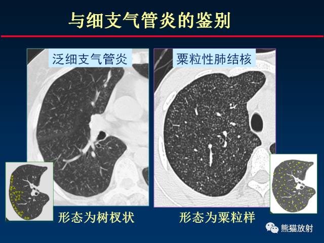 【PPT】肺结核的基础CT表现