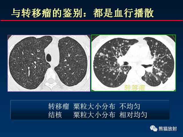 【PPT】肺结核的基础CT表现
