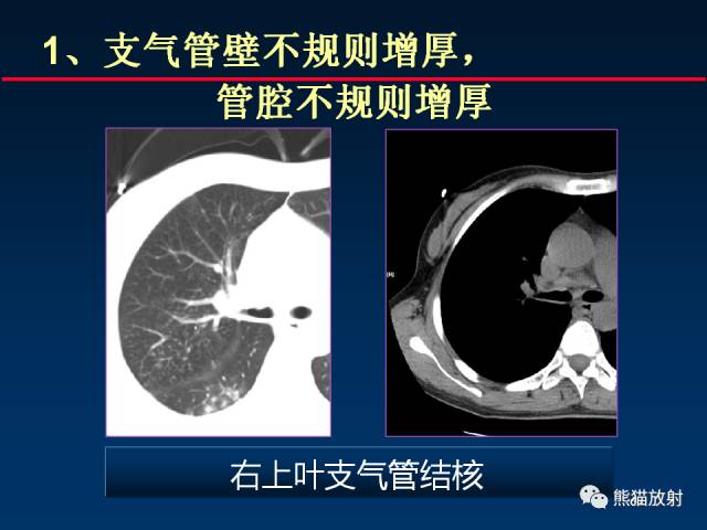 【PPT】肺结核的基础CT表现