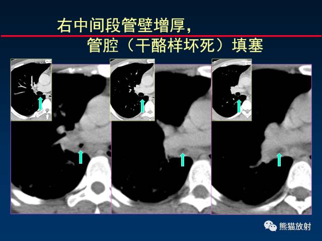 【PPT】肺结核的基础CT表现