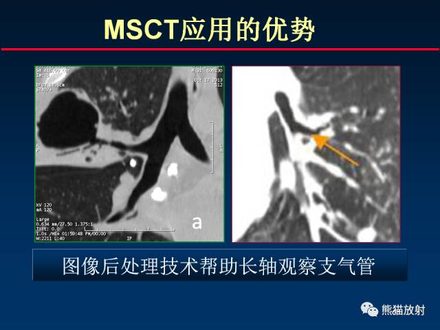 【PPT】肺结核的基础CT表现