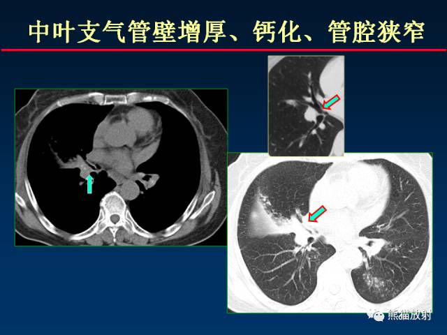 【PPT】肺结核的基础CT表现