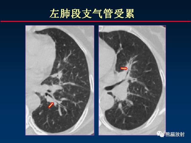 【PPT】肺结核的基础CT表现