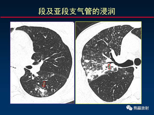 【PPT】肺结核的基础CT表现