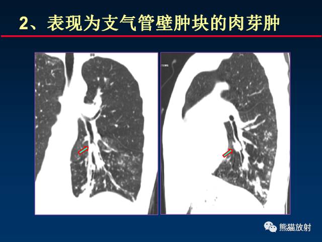 【PPT】肺结核的基础CT表现